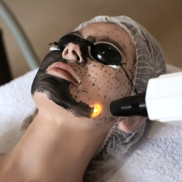 carbon-peeling